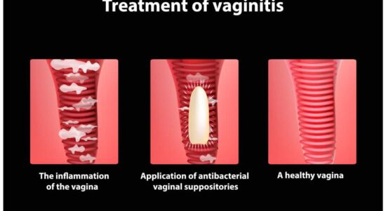 radang vagina