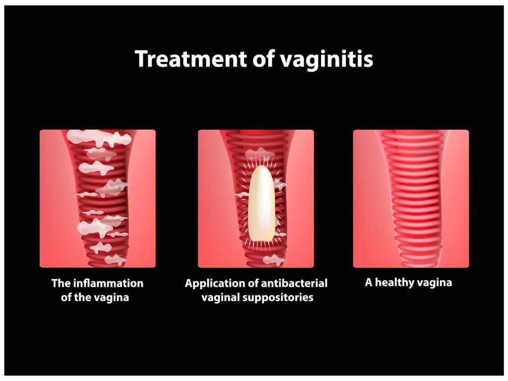 radang vagina
